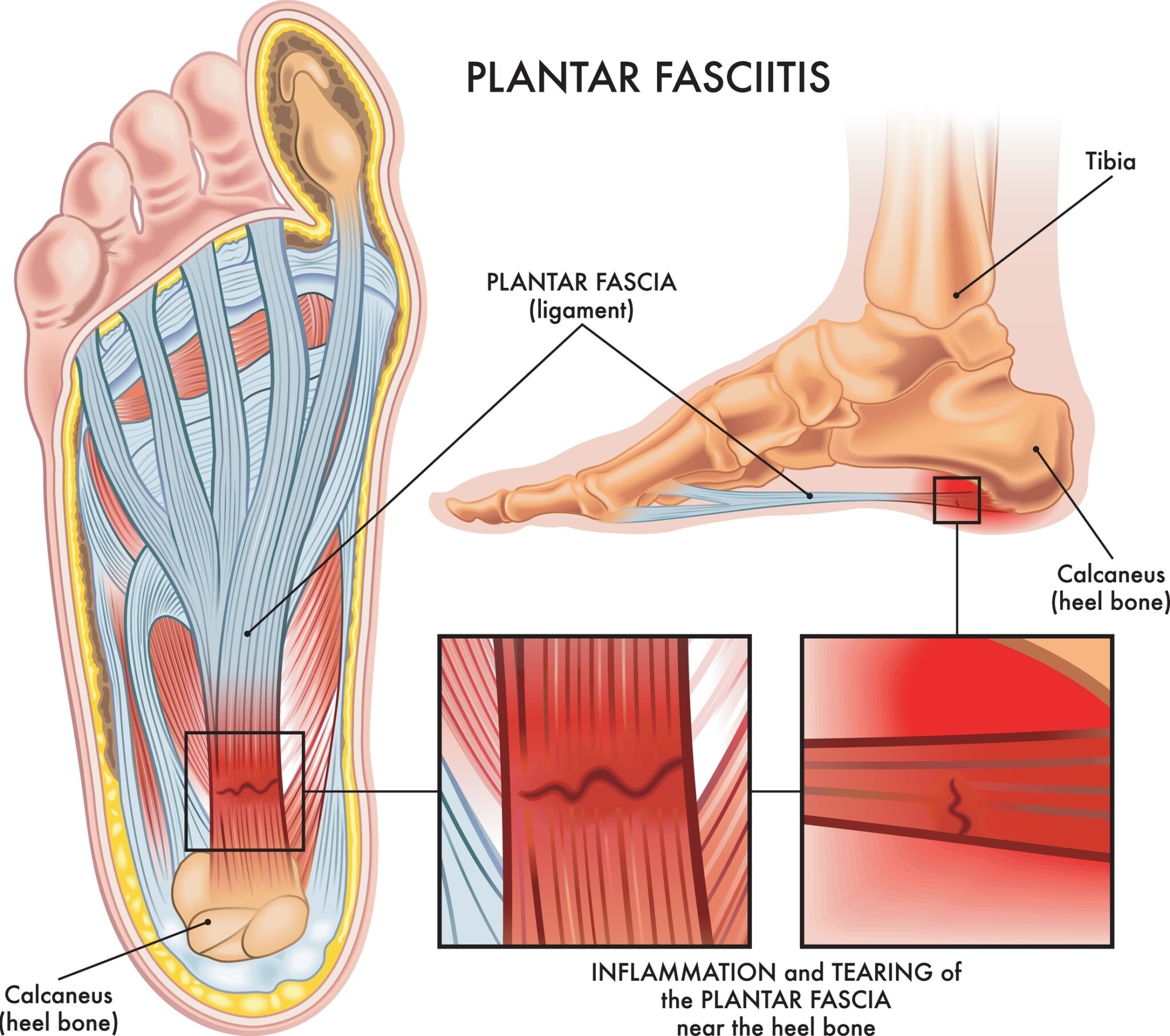 Combat Plantar Fasciitis During Foot Health Awareness Month - The